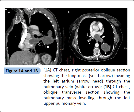 archivesofmedicine-pulmonary-vein