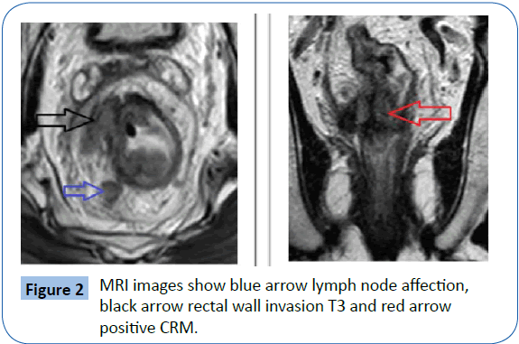 archivesofmedicine-rectal-wall