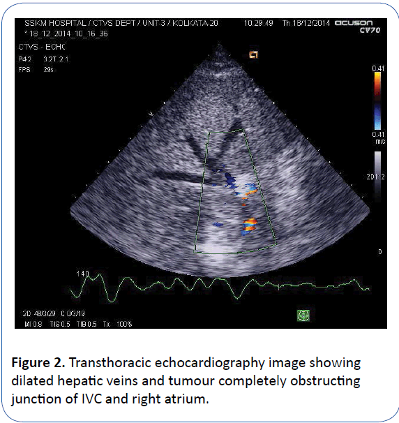 archivesofmedicine-right-atrium