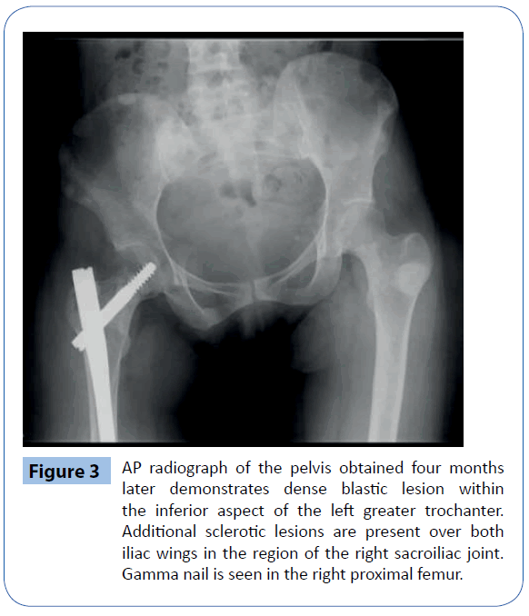 archivesofmedicine-right-proximal-femur