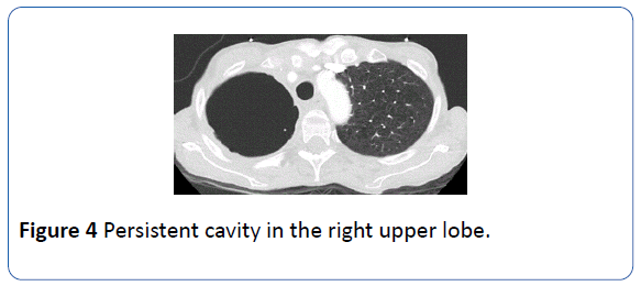 archivesofmedicine-right-upper-lobe