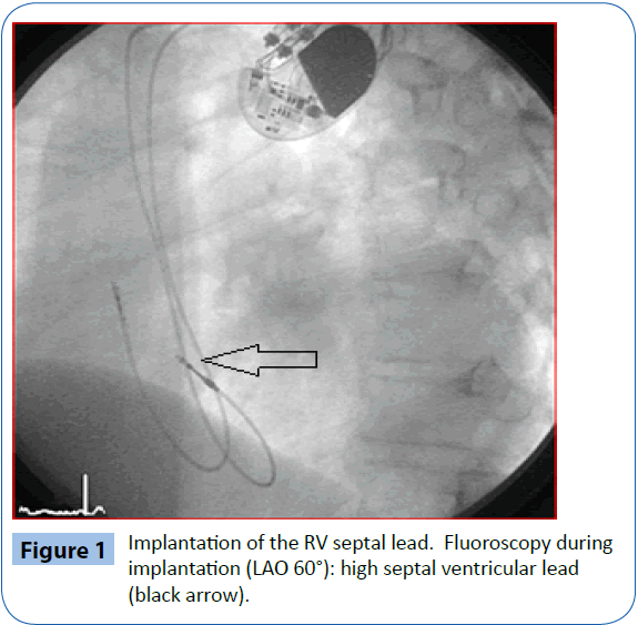 archivesofmedicine-septal-lead