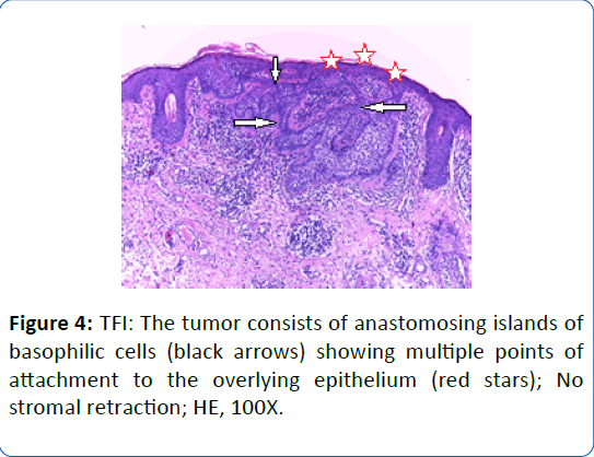 archivesofmedicine-stromal-retraction