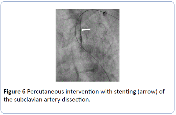 archivesofmedicine-subclavian-artery-dissection