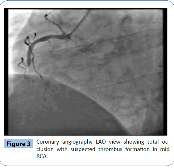 archivesofmedicine-suspected-thrombus