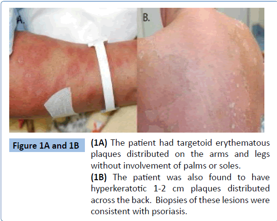 archivesofmedicine-targetoid-erythematous