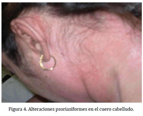 archivosdemedicina-Alteraciones-psoriasiformes