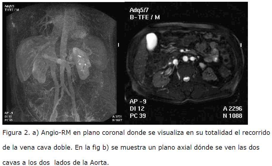 archivosdemedicina-Angio-RM