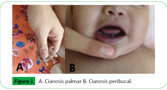 archivosdemedicina-Cianosis-palmar