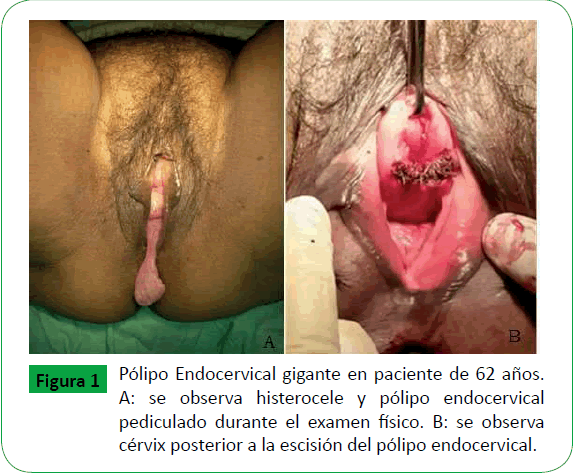 archivosdemedicina-Endocervical-gigante