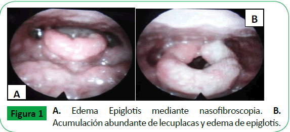 archivosdemedicina-Epiglotis-mediante