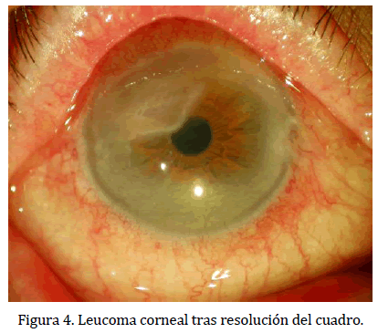 archivosdemedicina-Leucoma-corneal