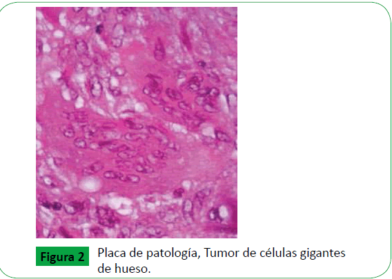 archivosdemedicina-Placa-Tumor