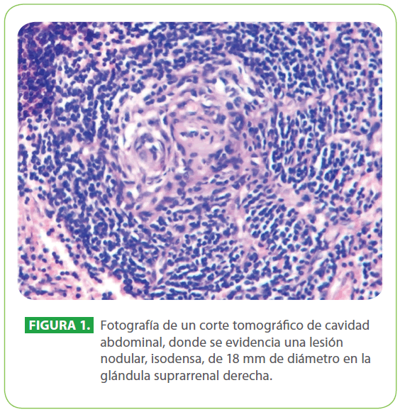 archivosdemedicina-abdominal-donde