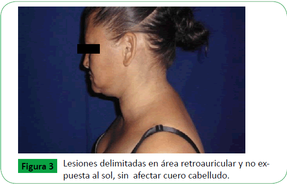 Dermatitis Cenicienta