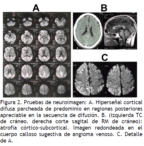 archivosdemedicina-angioma-venoso