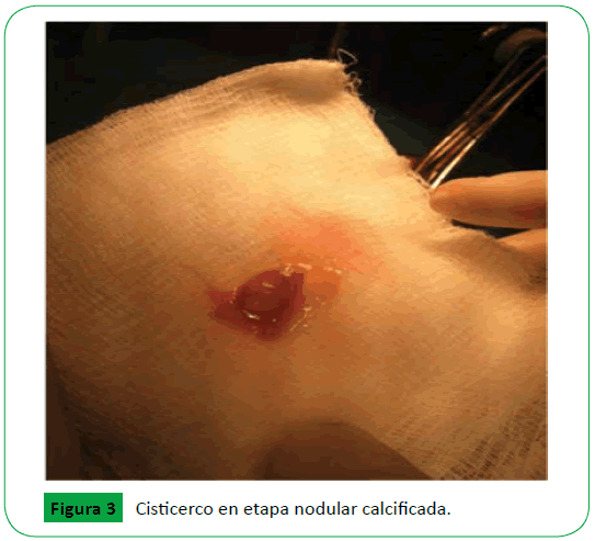 archivosdemedicina-calcificada