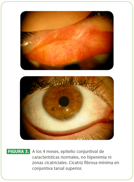 archivosdemedicina-conjuntiva-tarsal