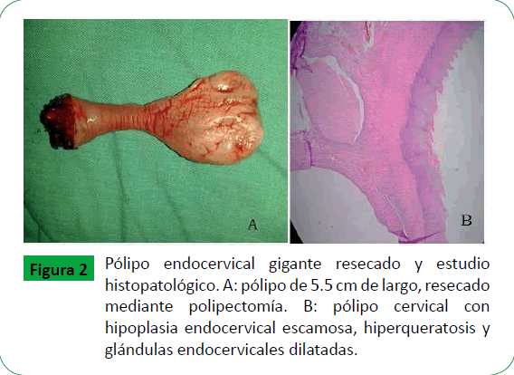 archivosdemedicina-endocervical-escamosa