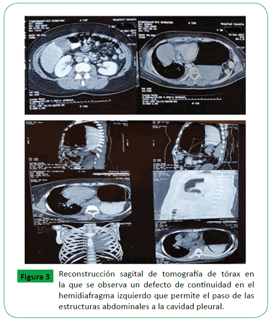 archivosdemedicina-hemidiafragma