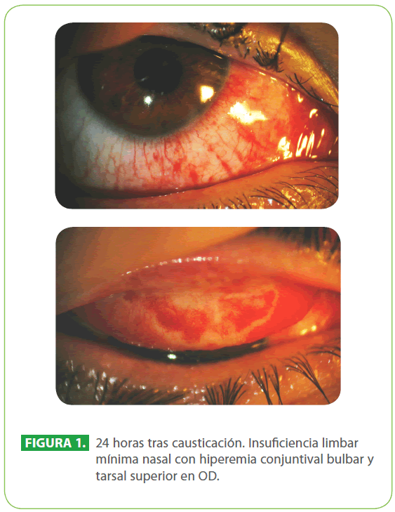 archivosdemedicina-hiperemia-conjuntival