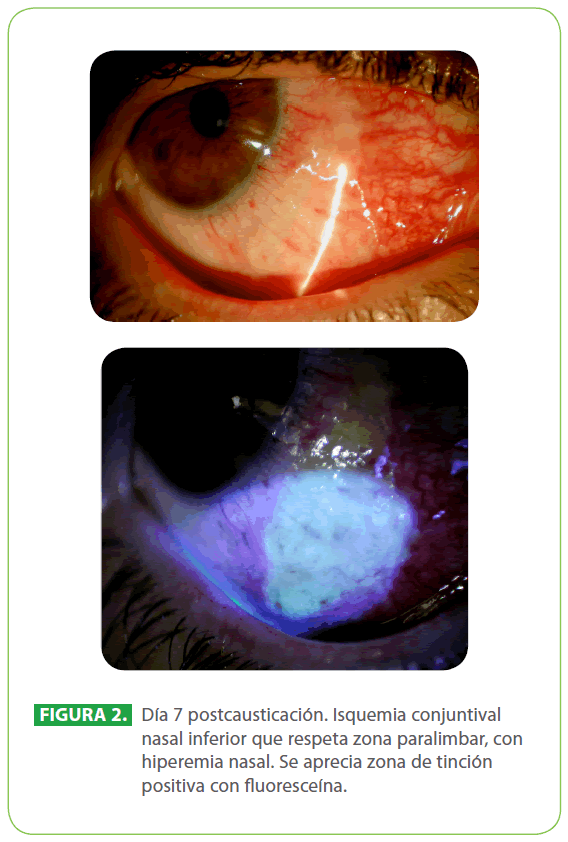 archivosdemedicina-hiperemia-nasal