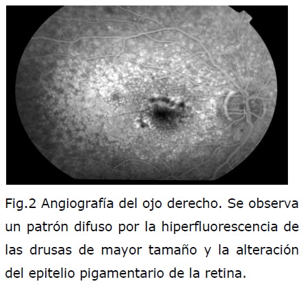 archivosdemedicina-hiperfluorescencia