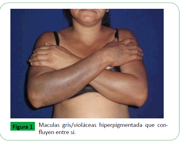 Dermatitis Cenicienta