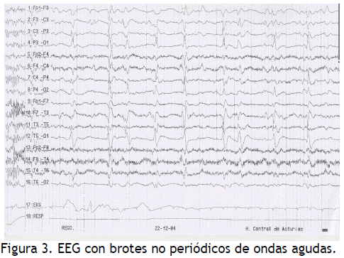 archivosdemedicina-ondas-agudas