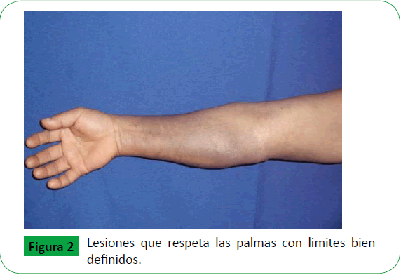 Dermatitis Cenicienta