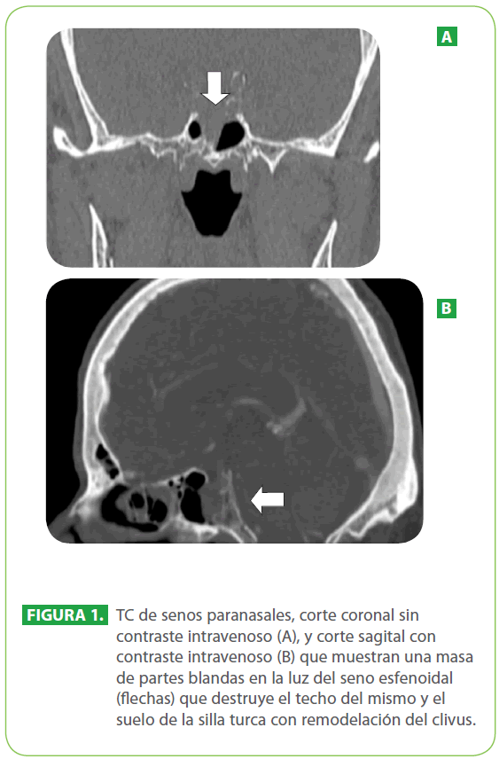 archivosdemedicina-senos-paranasales