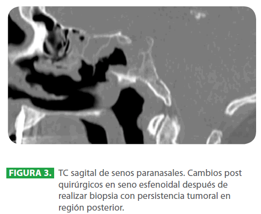 archivosdemedicina-senos-paranasales