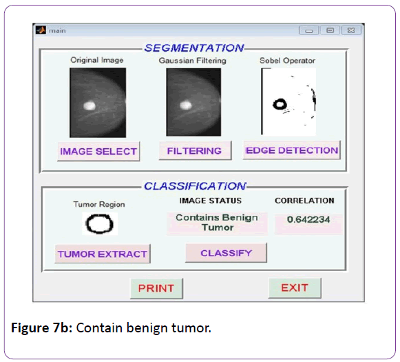 biomedical-sciences-Contain-benign-tumor