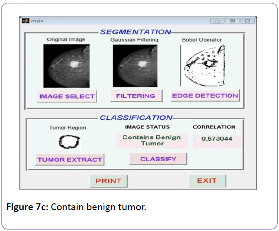 biomedical-sciences-Contain-benign-tumor