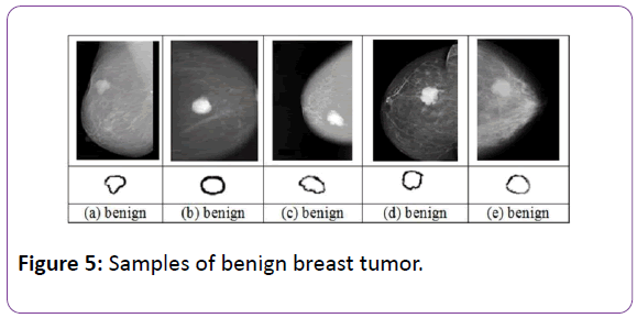 biomedical-sciences-benign-breast-tumor