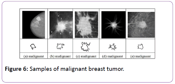biomedical-sciences-malignant-breast-tumor