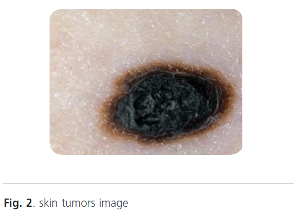 biomedical-sciences-skin-tumors