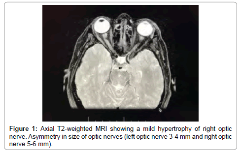 drug-development-research-mild-hypertrophy