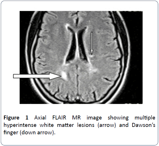 hsj-axial-hyperintense