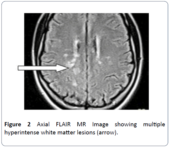 hsj-axial-hyperintense