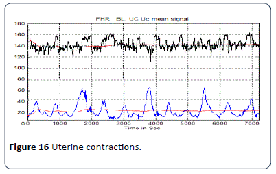 hsj-contractions