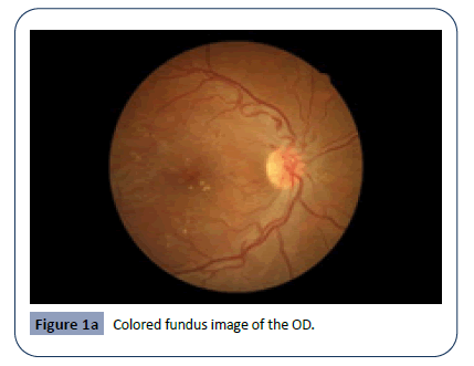 hsj-fundus