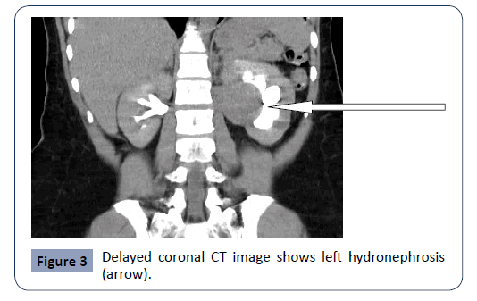 hsj-hydronephrosis