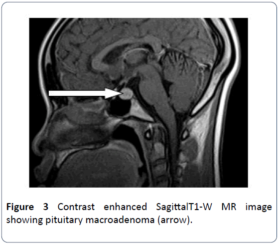hsj-pituitary-macroadenoma