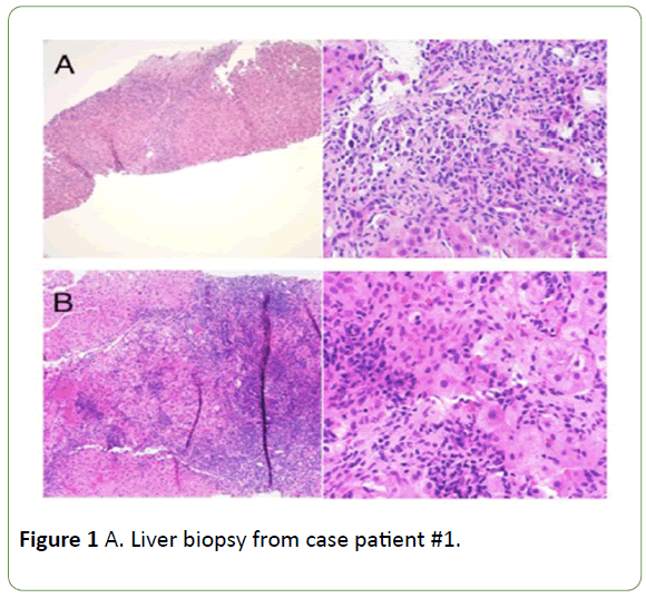 jbiomeds-Liver-biopsy
