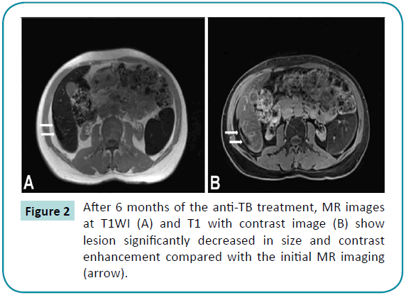 jbiomeds-anti-TB-treatment