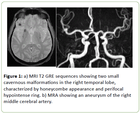 jbiomeds-cavernous-malformations