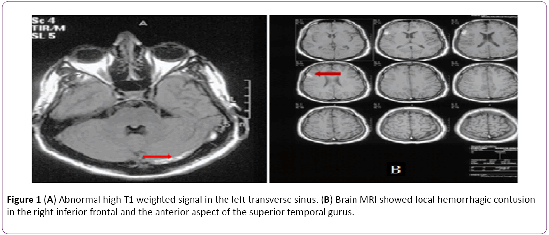 jneuro-Abnormal-high-T1-weighted