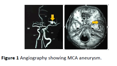 jneuro-Angiography