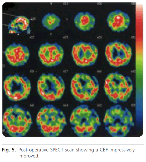 jneuro-CBF-impressively